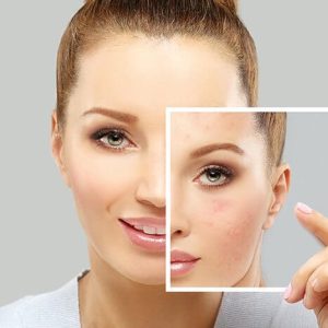 Acne-Skin-Rejuvenation